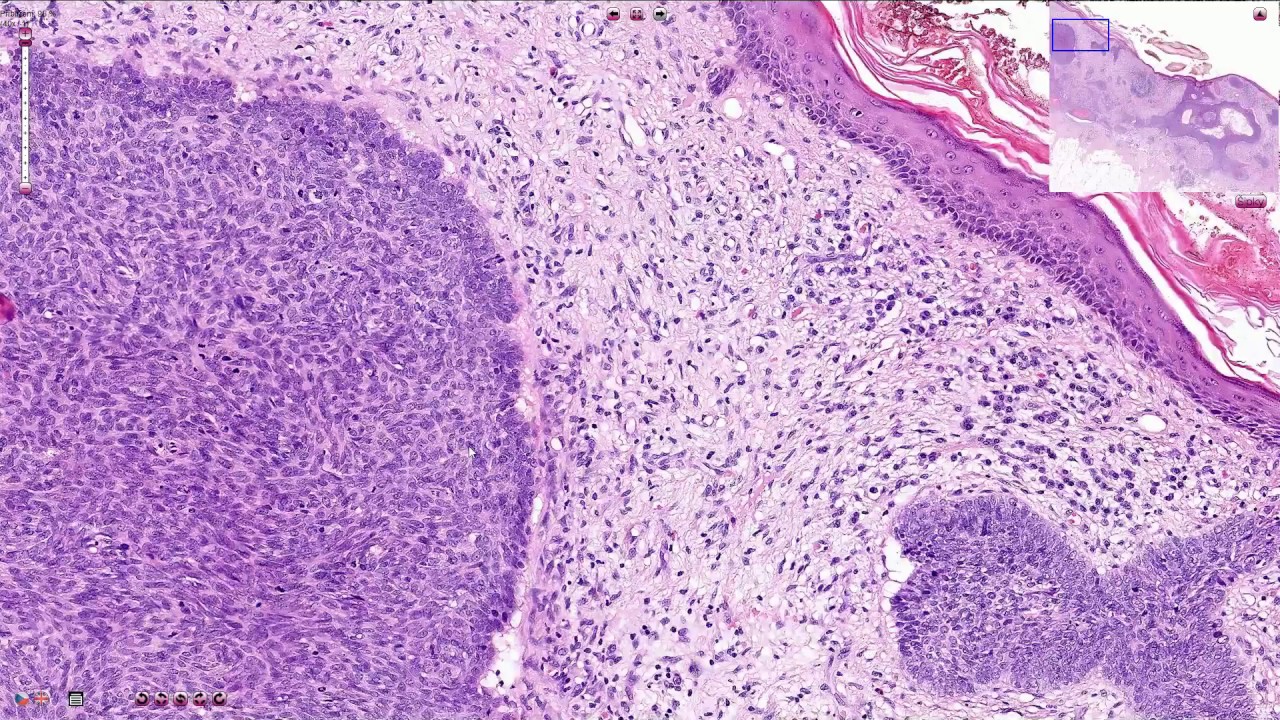 Basal Cell Carcinoma Variants