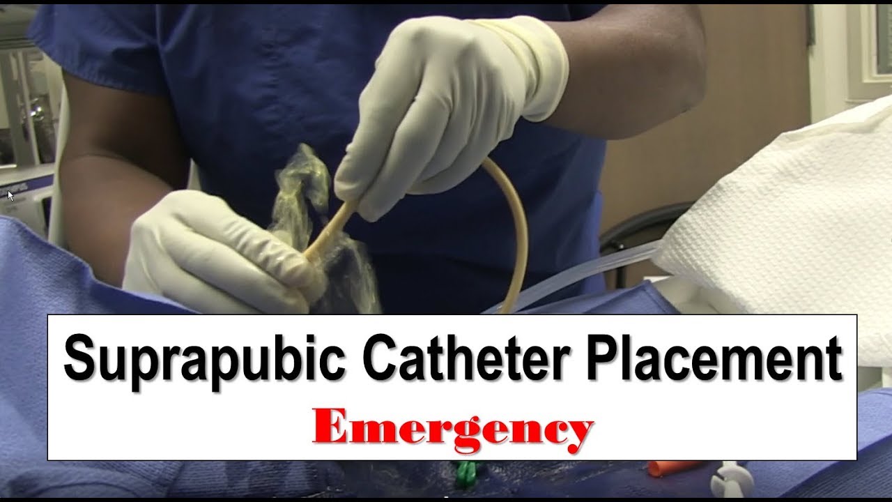 Emergency Suprapubic Catheter Placement - YouTube