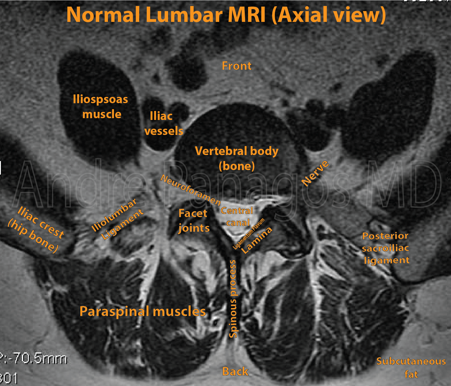 Lumbar Plexus Anatomy Mri | Images and Photos finder