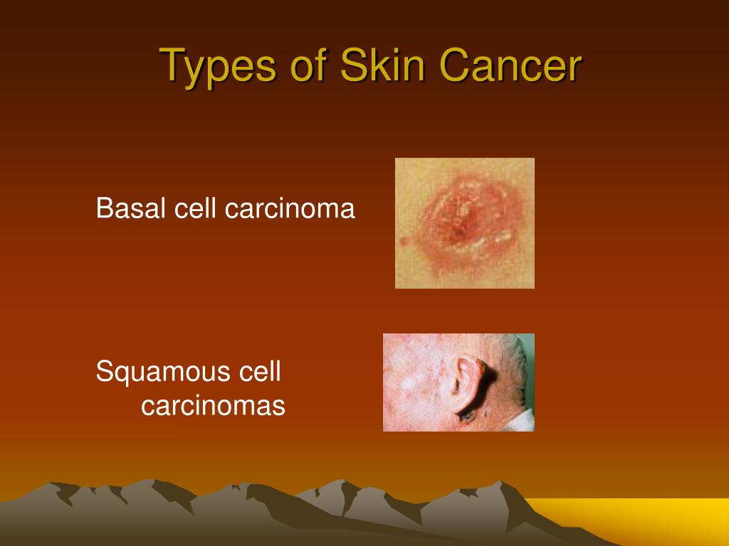 PPT - The Dangers of Skin Cancer PowerPoint Presentation, free download ...