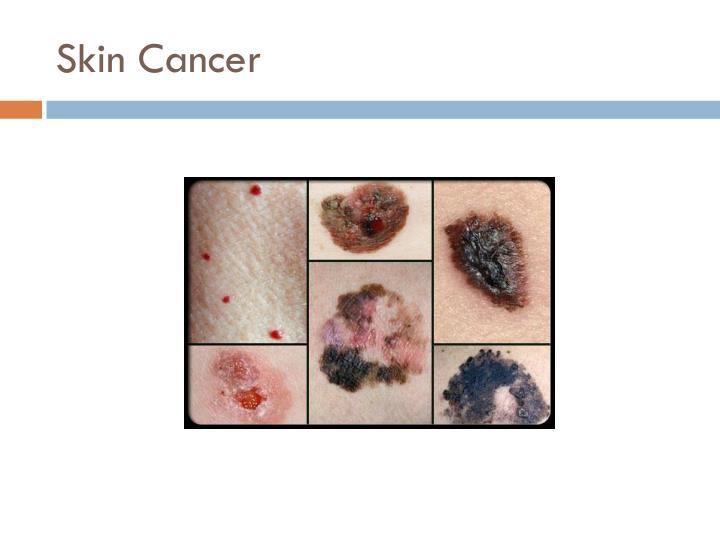 PPT - SKIN CANCER PowerPoint Presentation - ID:3634974