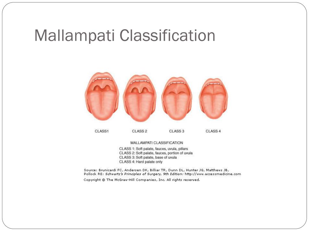 Mallampati Classification In 2020 Nurse Anesthesia Em - vrogue.co