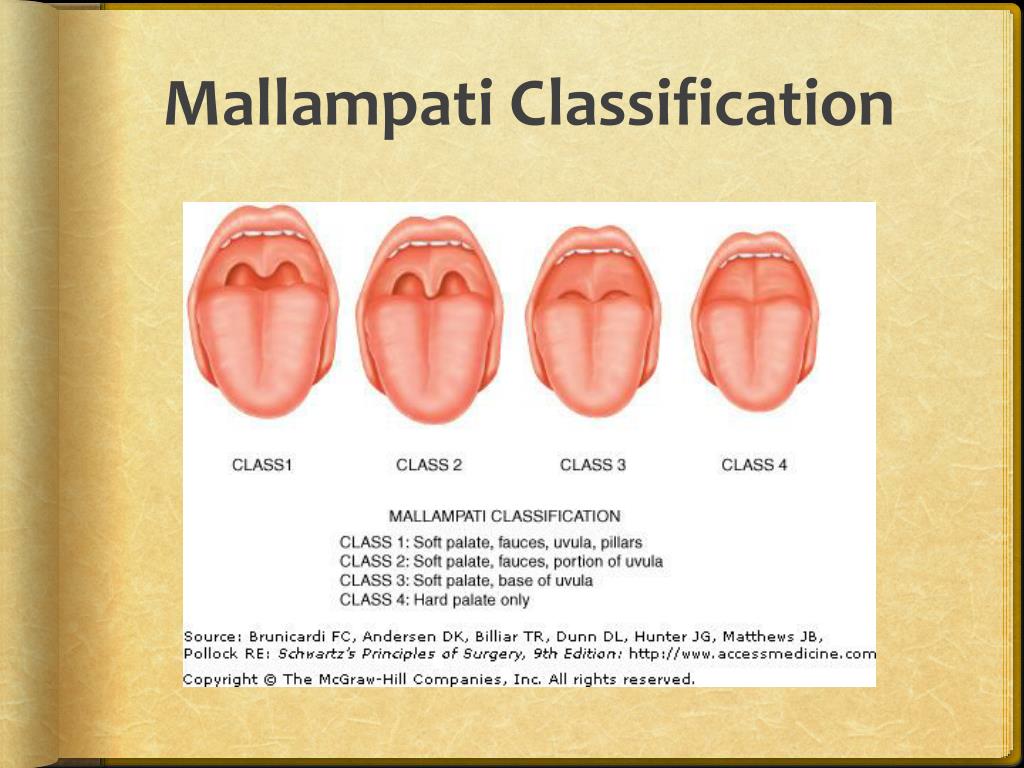 Mallampati Classification In 2020 Nurse Anesthesia Em - vrogue.co