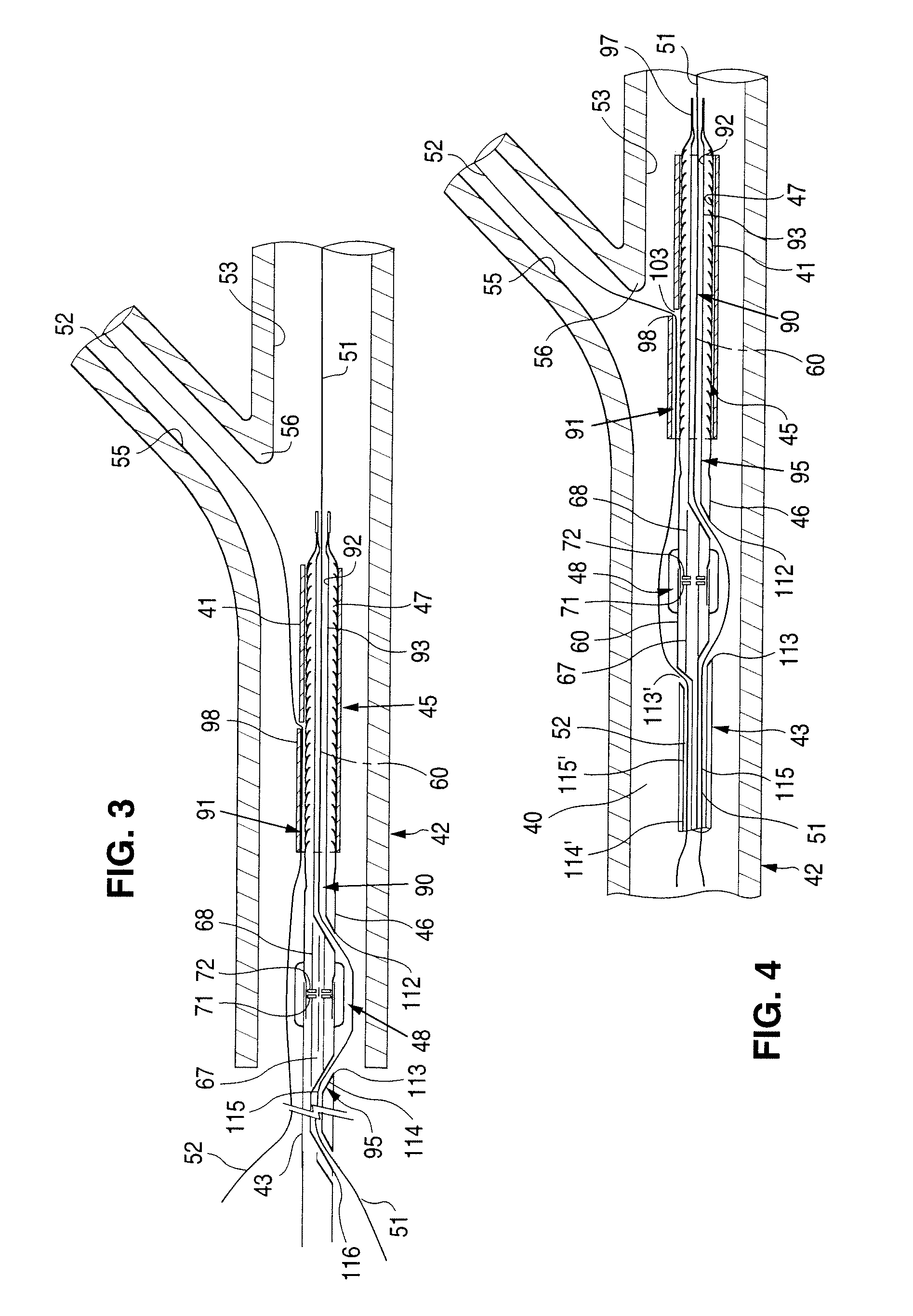 Bifurcation stent delivery catheter and method