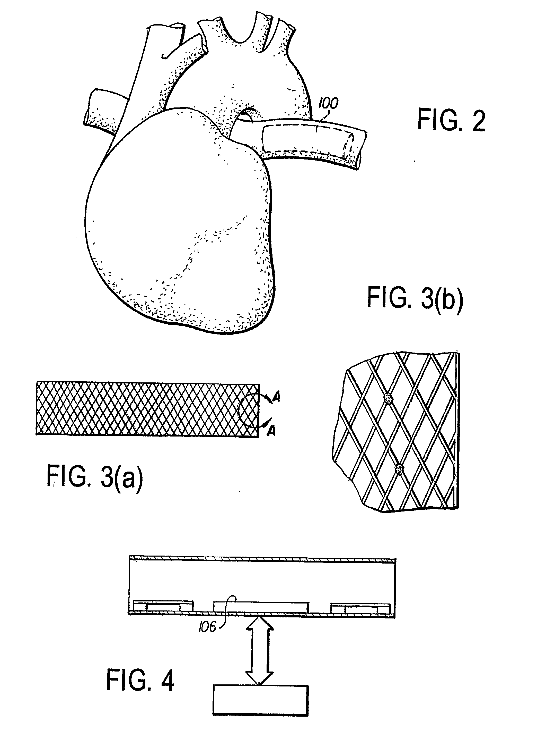 Leadless Implantable Intravascular Electrophysiologic Device for Neurologic/Cardiovascular Sensing and Stimulation