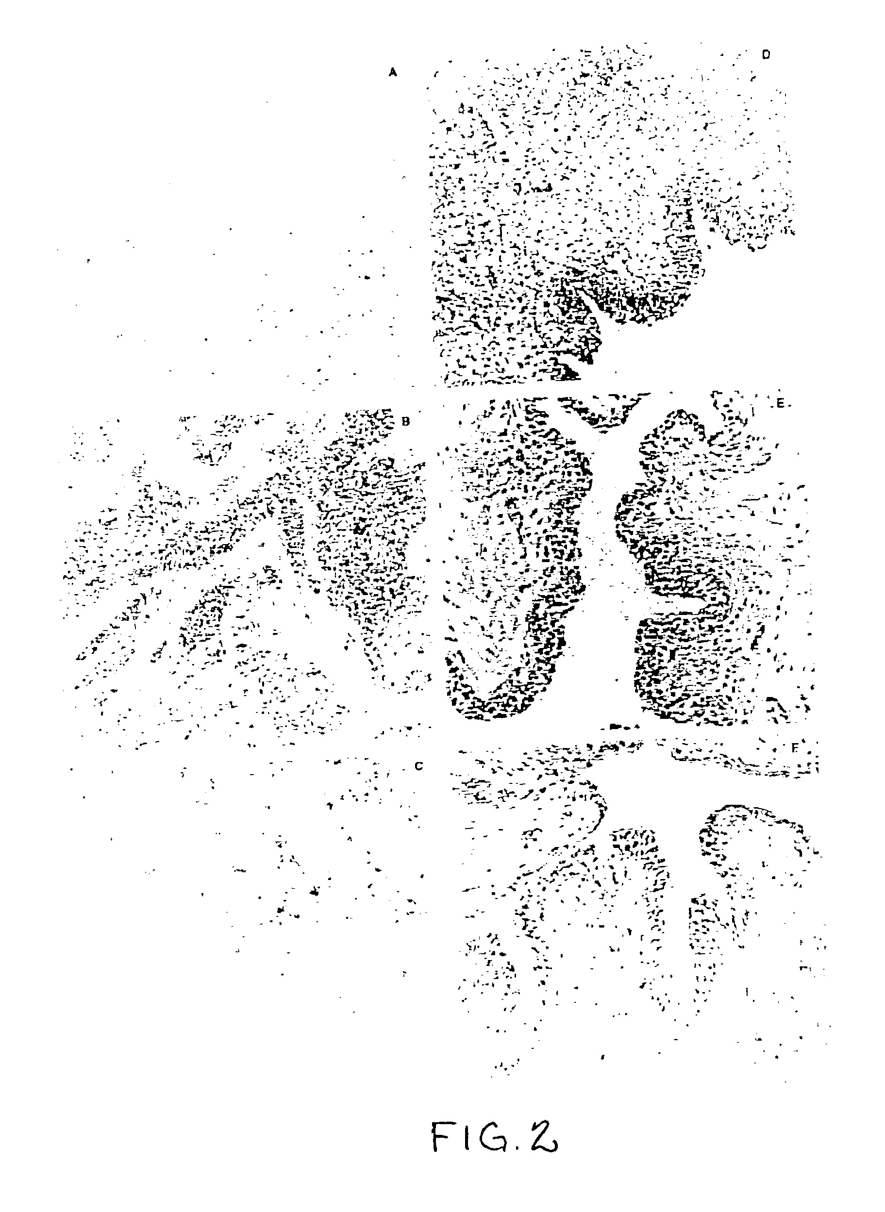 Medical compositions for intravesical treatment of bladder cancer