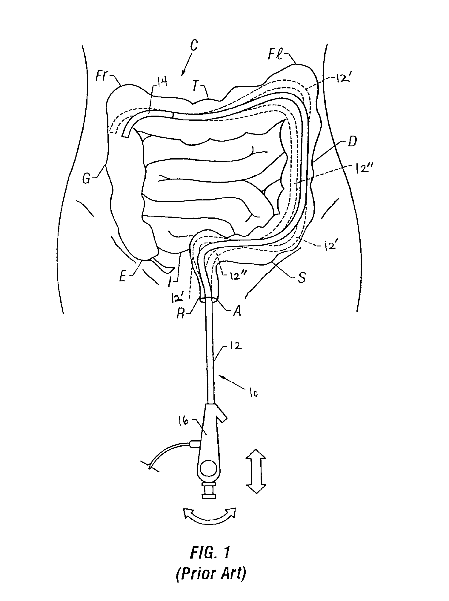 Endoscope with single step guiding apparatus