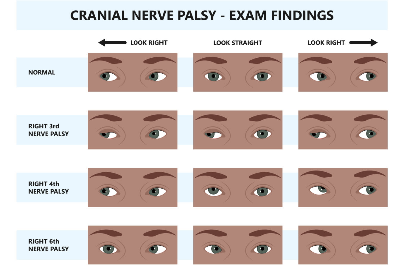 Notez On Nursing Cranial Nerve Iii