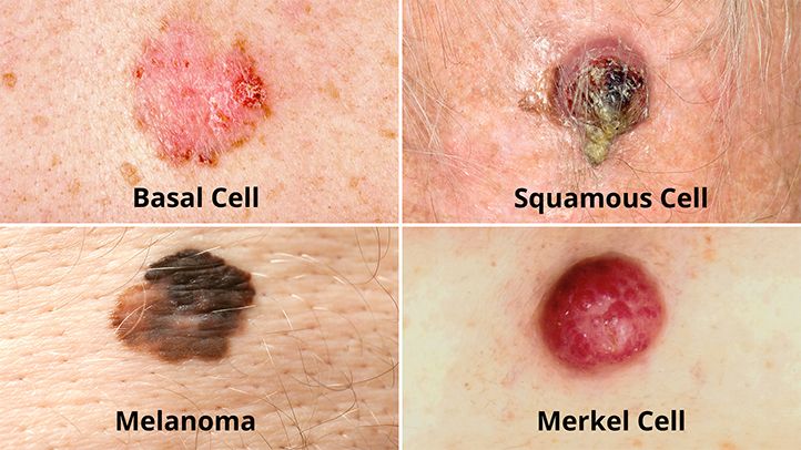 What Are the Different Types of Skin Cancer? | Christ Memorial