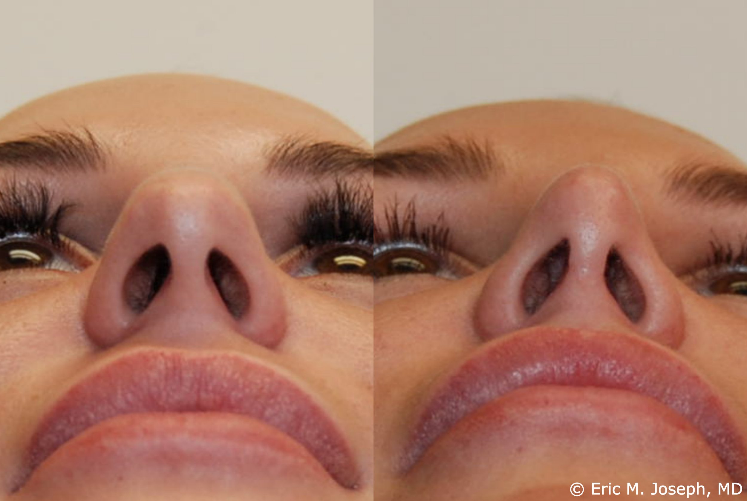 primary-rhinoplasty-nj-1228.jpg