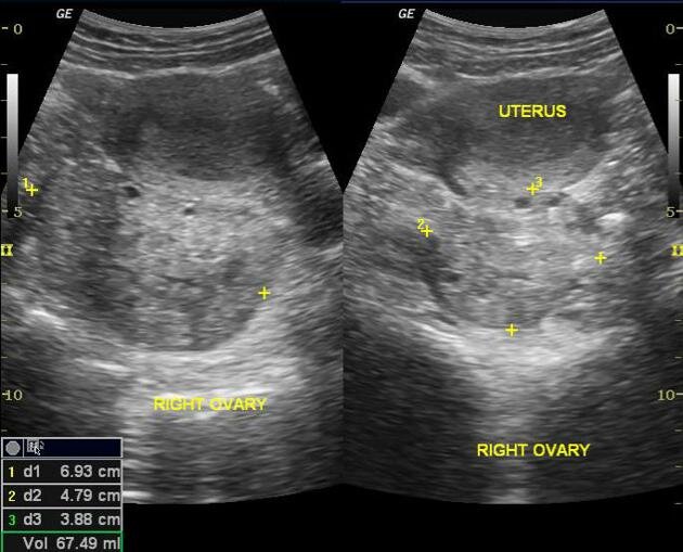 Ovarian Torsion