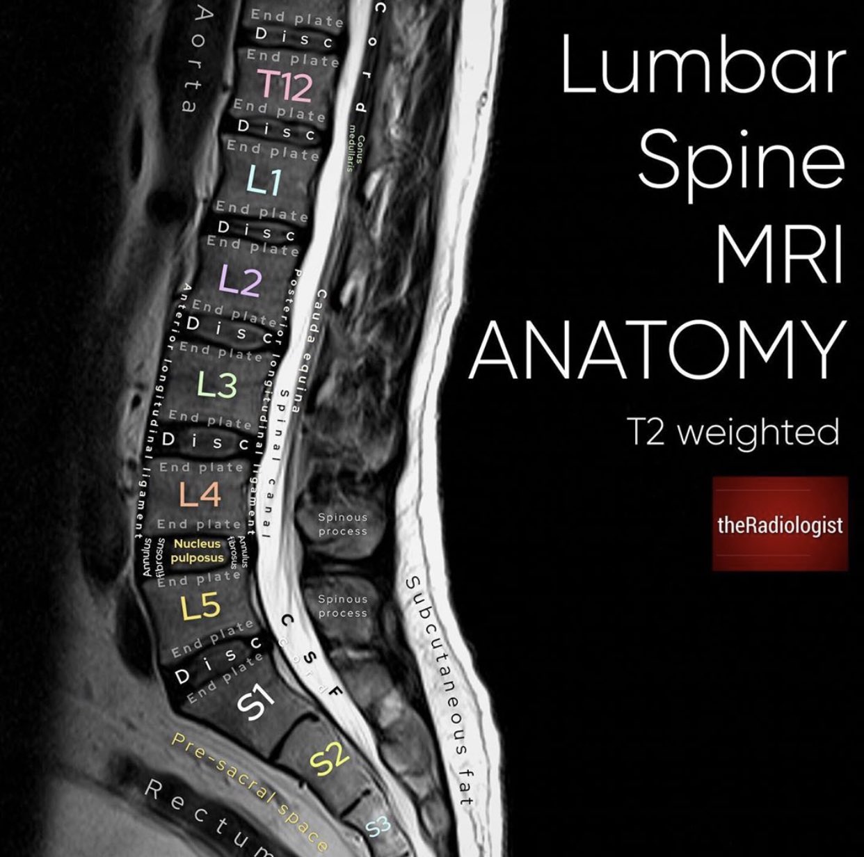 Lumbar Spine Mri Labeled