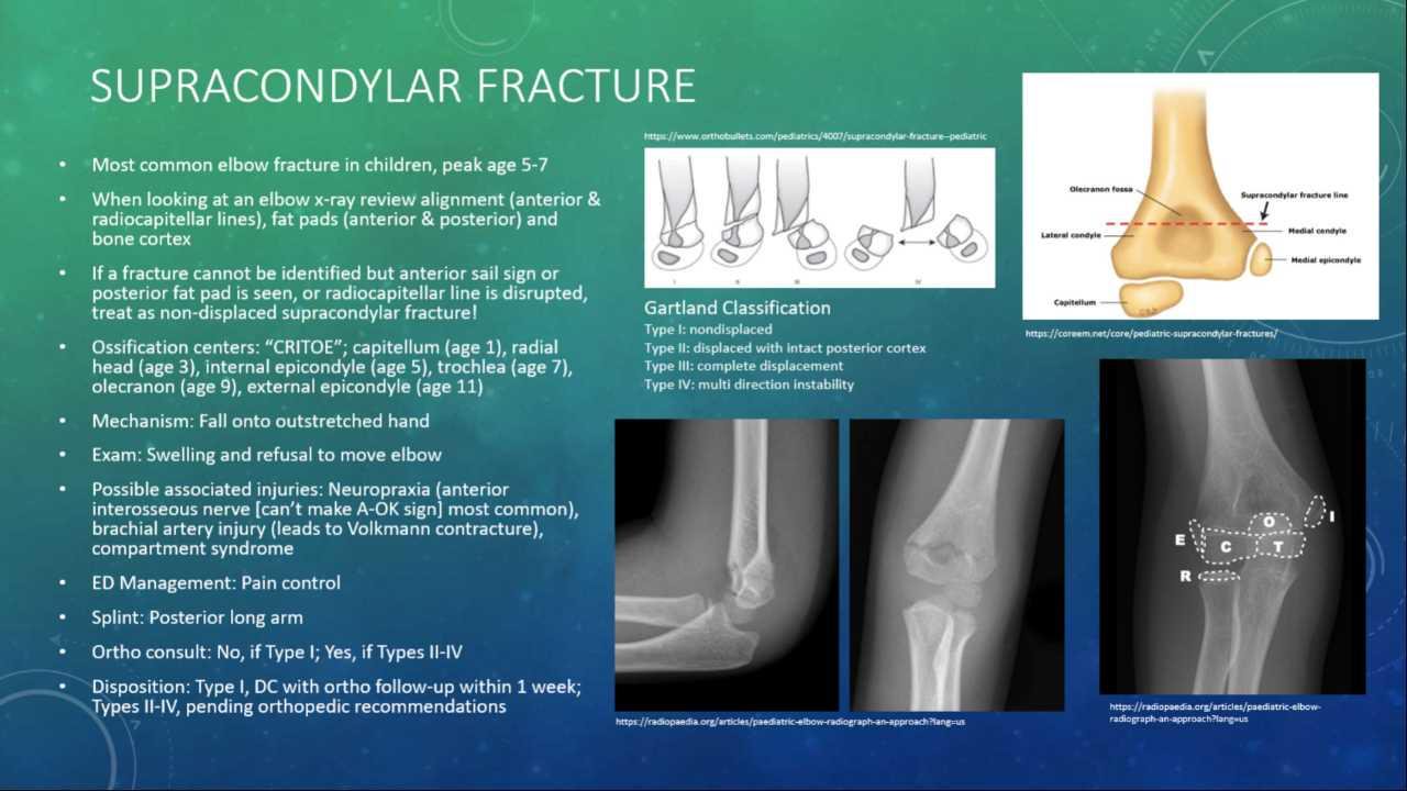 Types Of Fractures X Ray