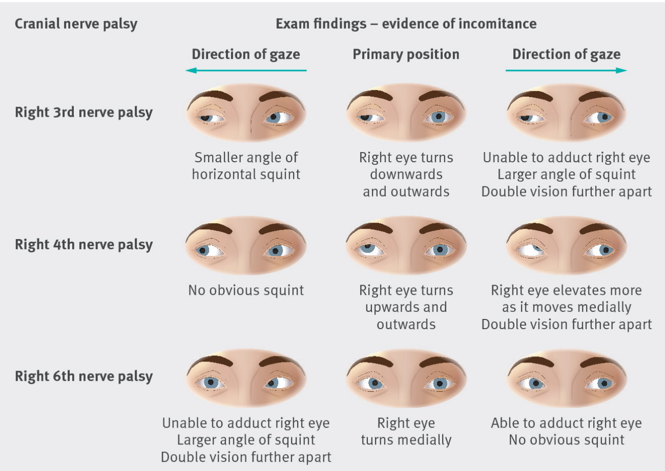 Oculomotor Nerve Palsy