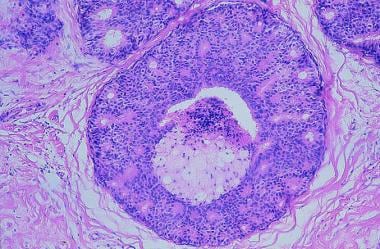 Invasive Ductal Carcinoma Histology