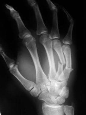 Metacarpal Fractures Workup: Plain Radiography