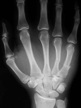 Metacarpal Fracture and Dislocation: Practice Essentials, Epidemiology ...