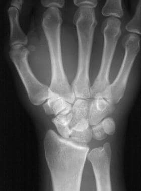 Wrist Dislocation in Sports Medicine Workup: Laboratory Studies ...