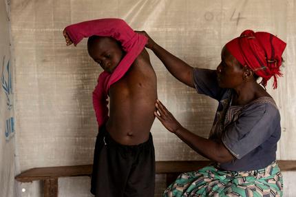 Mpox: Fideline Kiza Kasao, 45, checks the progress of her son Kito Balume after recovering from Mpox - an infectious disease caused by the monkeypox virus that spark-off a painful rash, enlarged lymph nodes and fever; sit outside their shelter at the Muja displaced persons camp, following Mpox cases in Nyiragongo territory near Goma, North Kivu province, Democratic Republic of the Congo July 18, 2024. REUTERS/Arlette Bashizi