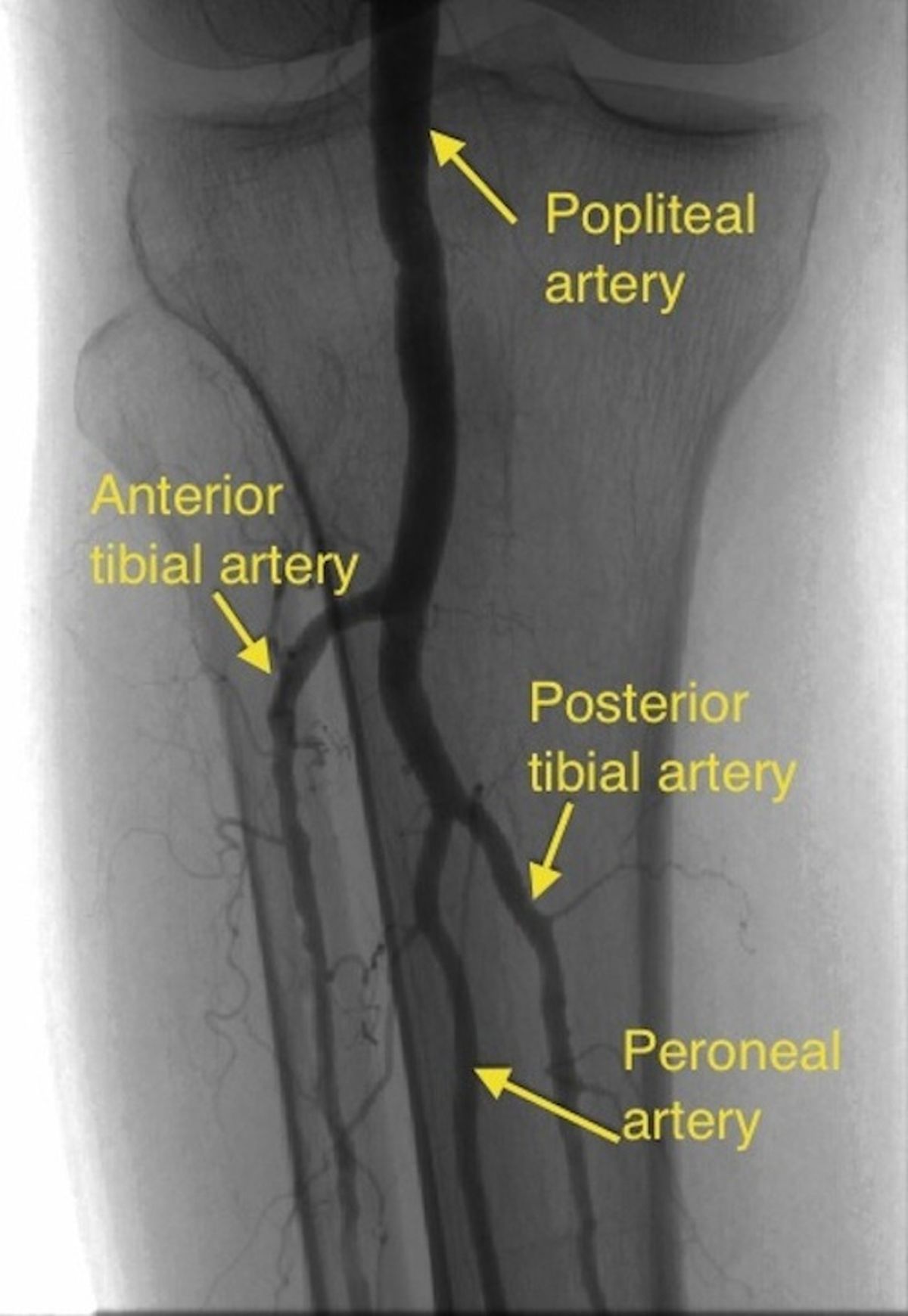 Popliteal Artery