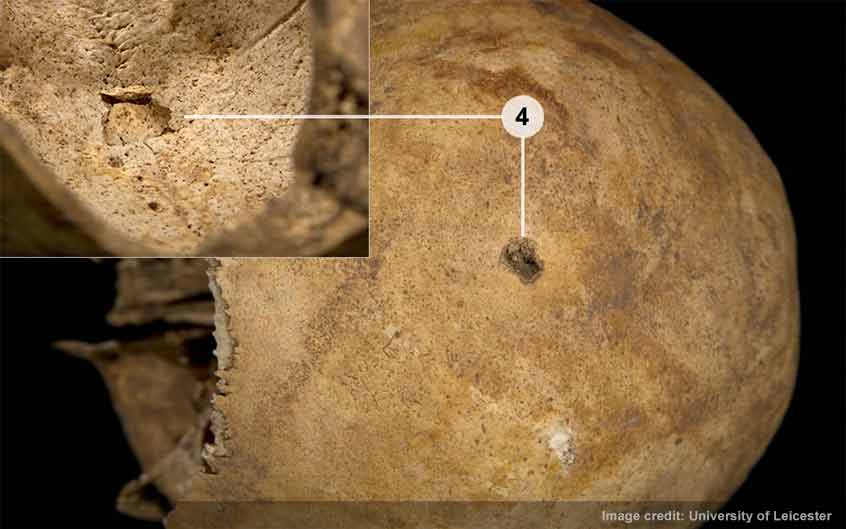 Small penetrating wound on the top of the skull