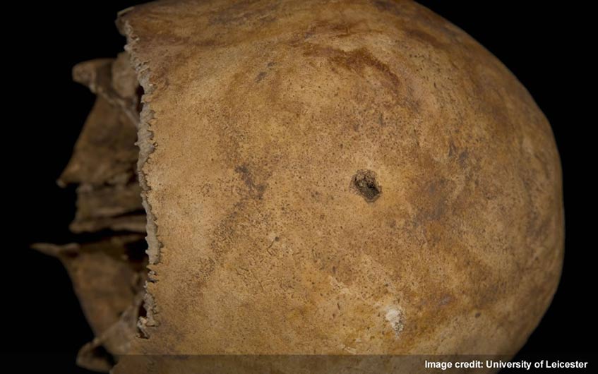 Small penetrating wound on the top of Richard III's skull