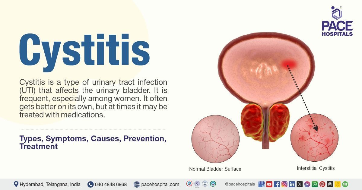 Cystitis Symptoms and Causes | Cystitis treatment in India | What is Cystitis | Cystitis meaning