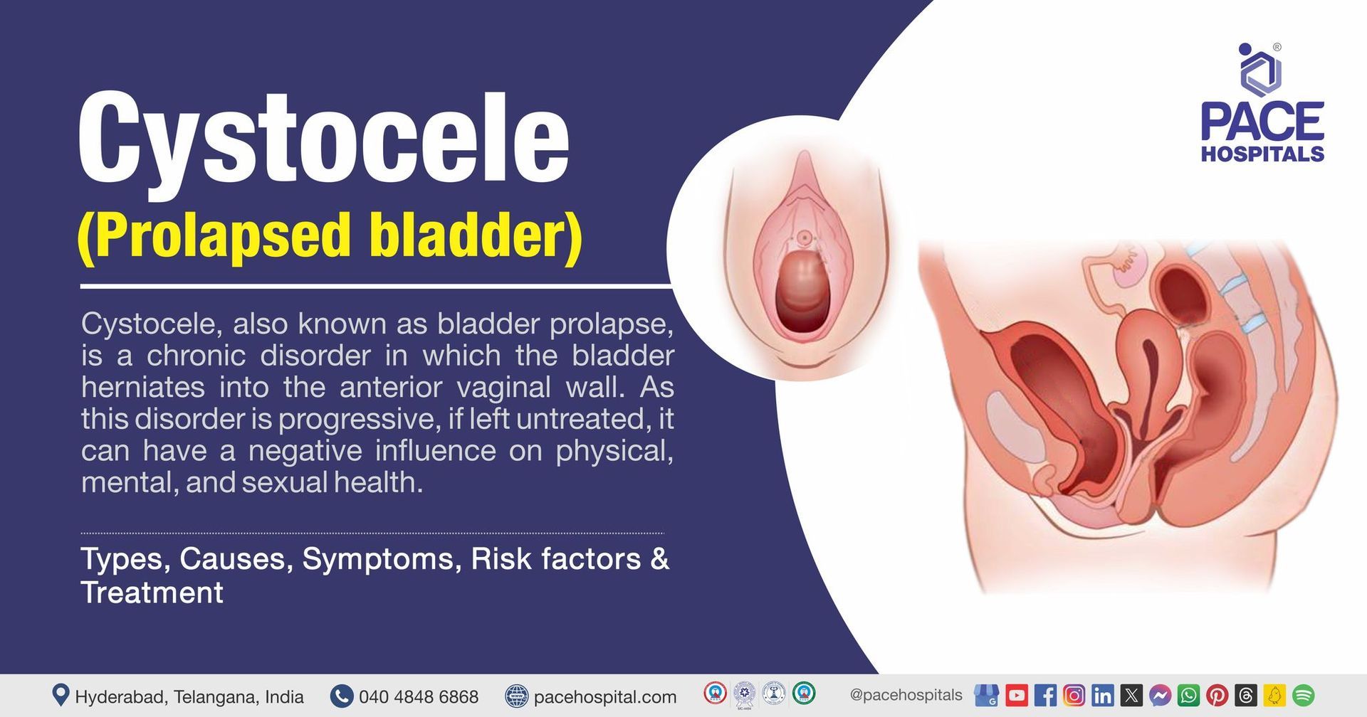 Cystocele symptoms | bladder prolapse symptoms | Cystocele treatment in India | cystocele prolapse