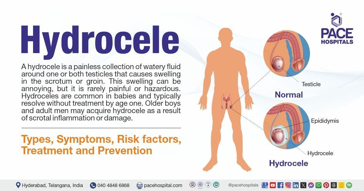 Hydrocele Symptoms & Causes, Hydrocele Treatment in India | Hydrocele meaning | What is Hydrocele 