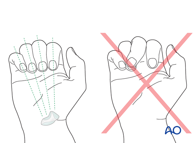 Correctly alignment of the flexed fingers pointing to the scaphoid and malaligned middle finger