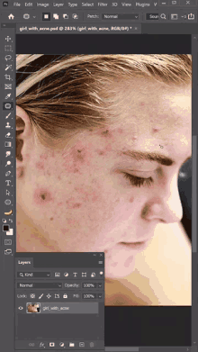 a screenshot of a woman 's face with acne on it