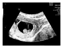 a black and white ultrasound of a baby with rab2-6-rs on the bottom