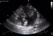 a black and white ultrasound image of a heart with a heart rate graph