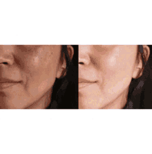 a before and after photo of a woman 's face with a lot of wrinkles .