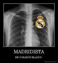 an x-ray of a person 's chest with a real madrid logo in it .