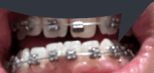 a close up of someone 's teeth with braces on them