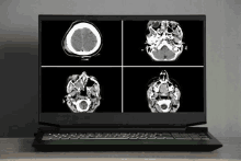 a laptop computer is displaying four ct images of a brain