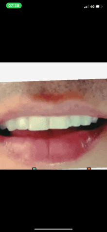 a close up of a person 's mouth and teeth with a time stamp of 7:38