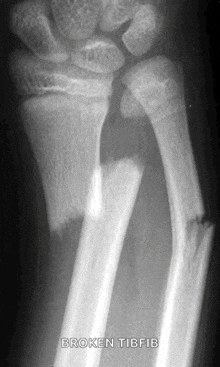 a black and white x-ray of a broken wrist with the words broken tibfib below it