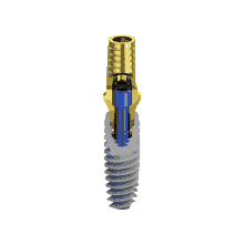 an illustration of a dental implant showing the inside of the screw