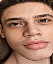 a close up of a young man 's face with acne on his forehead .