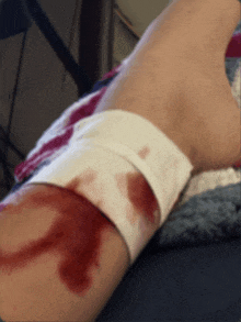 a person 's arm with blood on it and a bandage