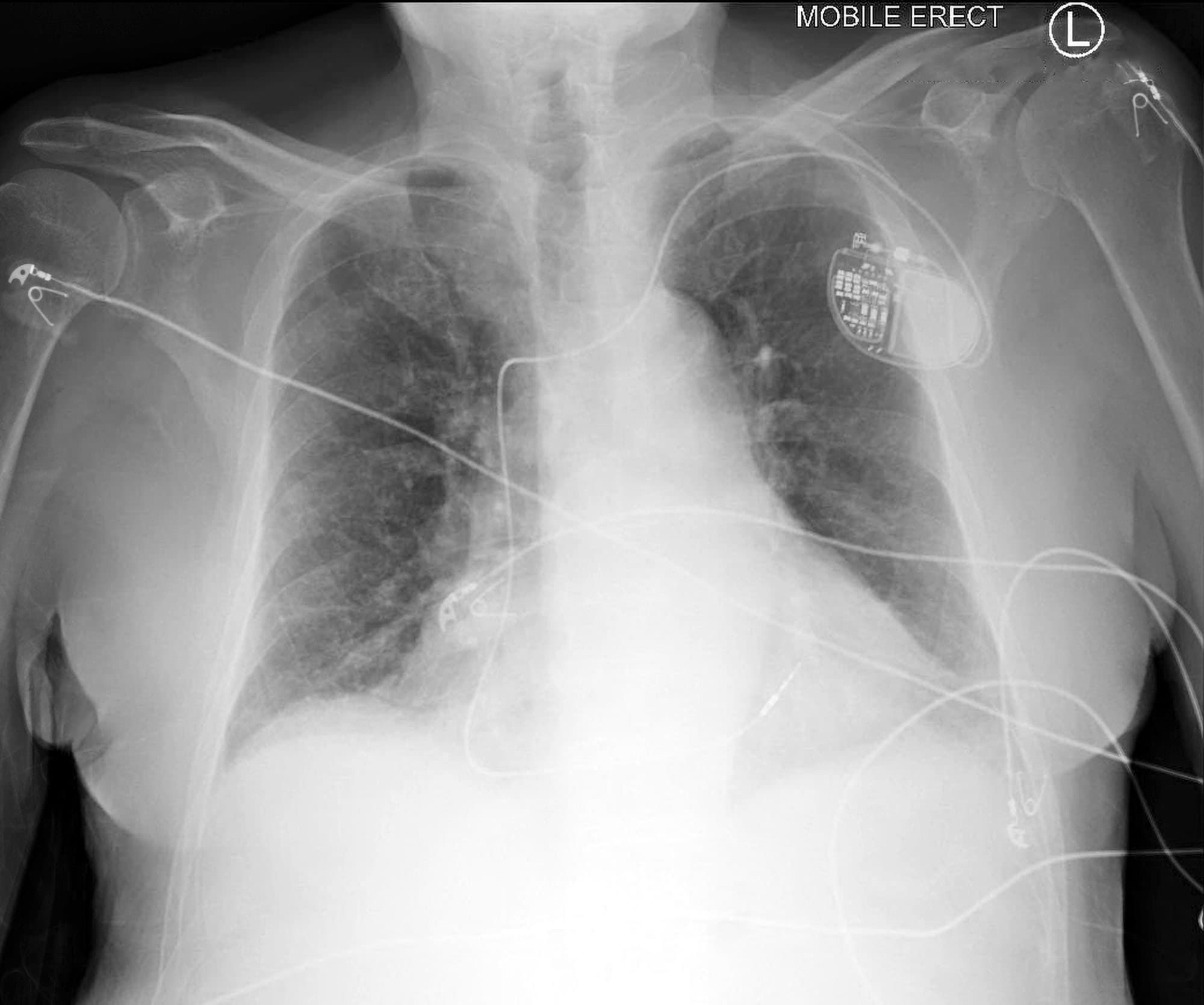 Pulmonary Edema Chest X Ray