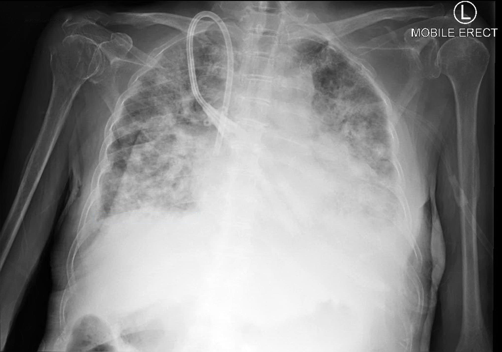 Pulmonary Edema X Ray Butterfly Pattern