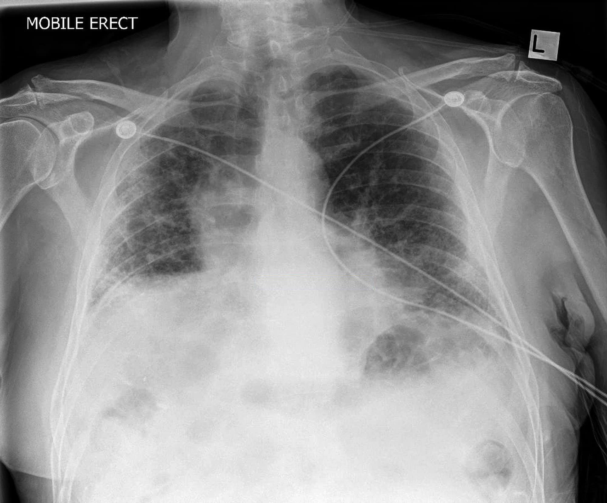 Interstitial Lung Disease X Ray