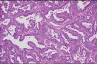 SciELO - Brasil - Malignant transformation of abdominal wall ...