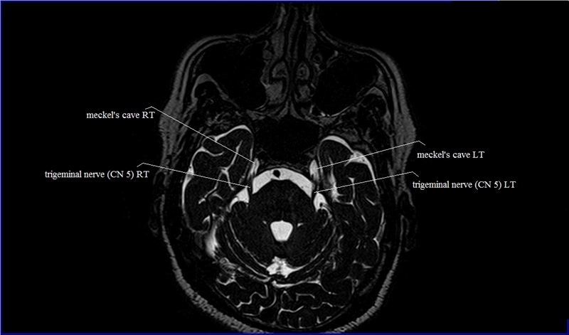 cranial nerves anatomy | MRI axial cranial nerves anatomy | free cross ...