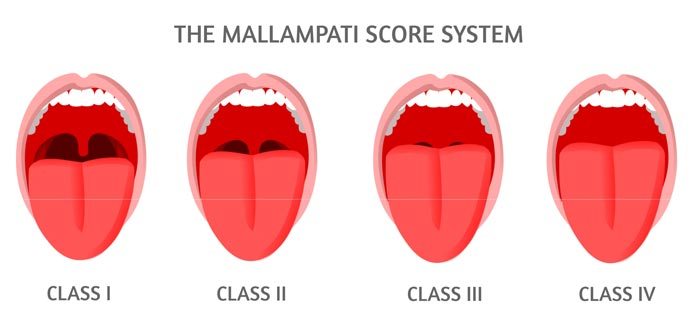 What Is The Mallampati Score? - Faceology