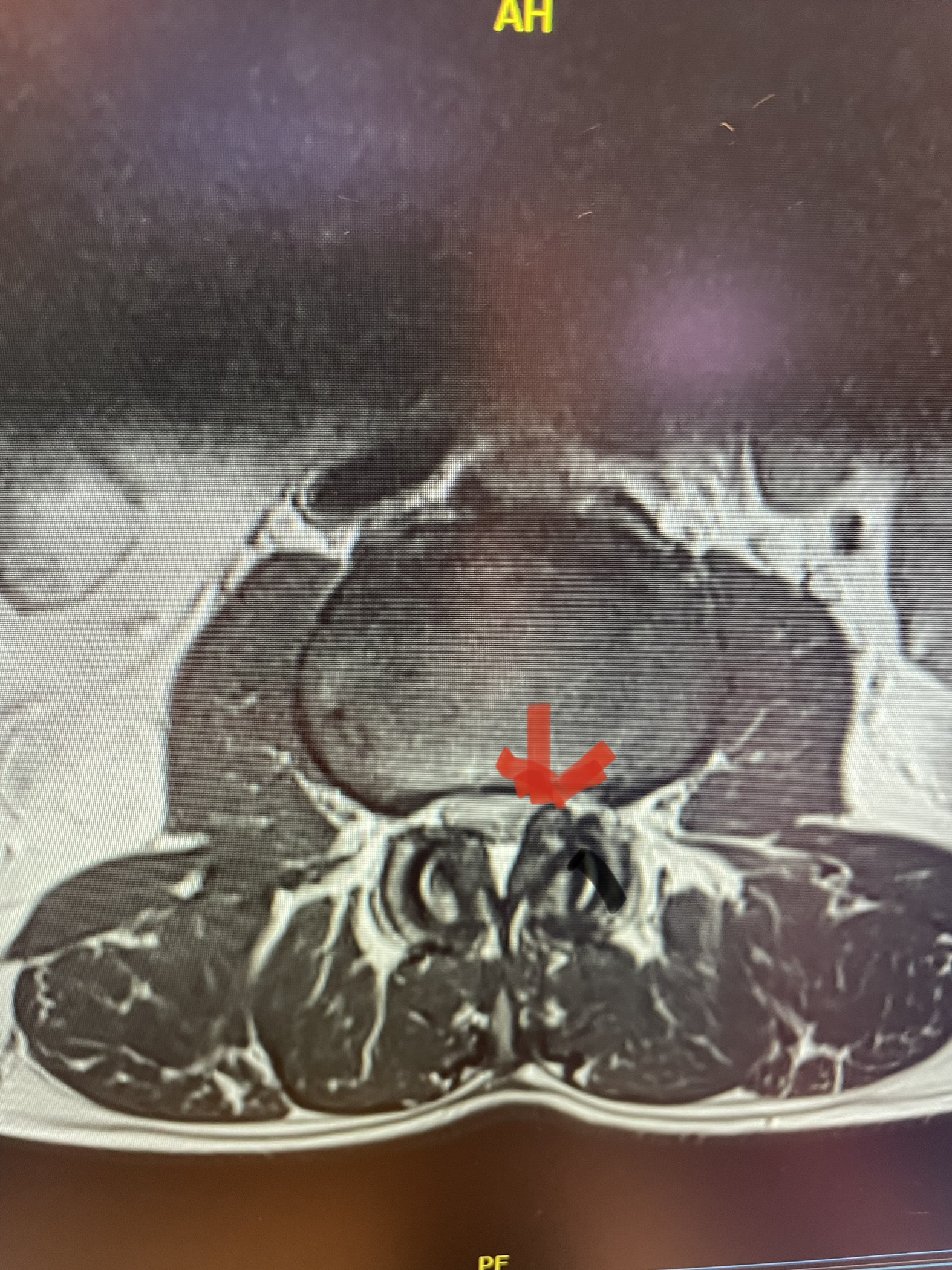 A Severe Stenosis And Occlusion Of The Proximal Part - vrogue.co