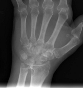 Rheumatologic conditions of the hand and wrist | Plastic Surgery Key